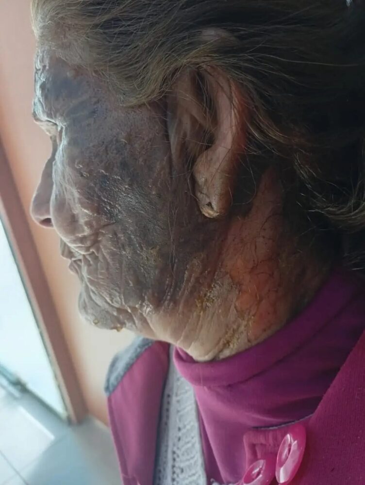 Mujer de 84 años con graves quemaduras en el rostro tras un ataque en Catamarca