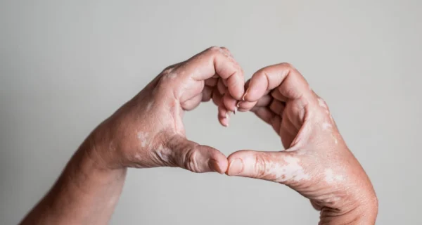 Día Mundial del Vitiligo