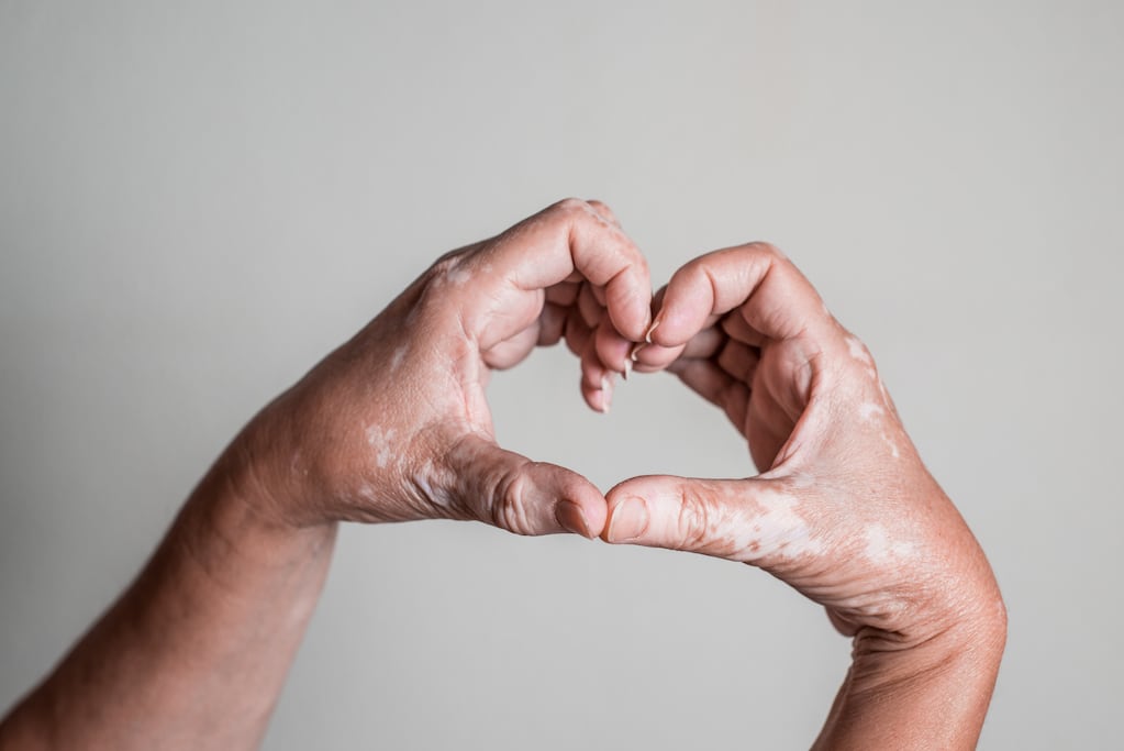 Día Mundial del Vitiligo