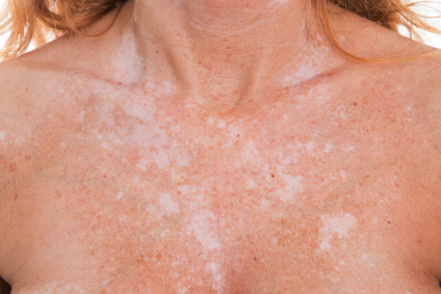Piel afectada por vitiligo en el pecho de una persona