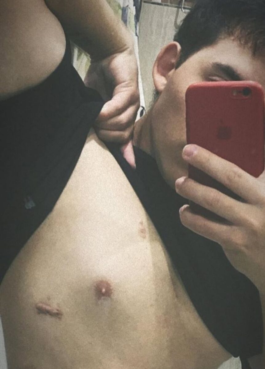 José Naón Giménez muestra las cicatrices en su abdomen tras la masacre de Cañuelas
