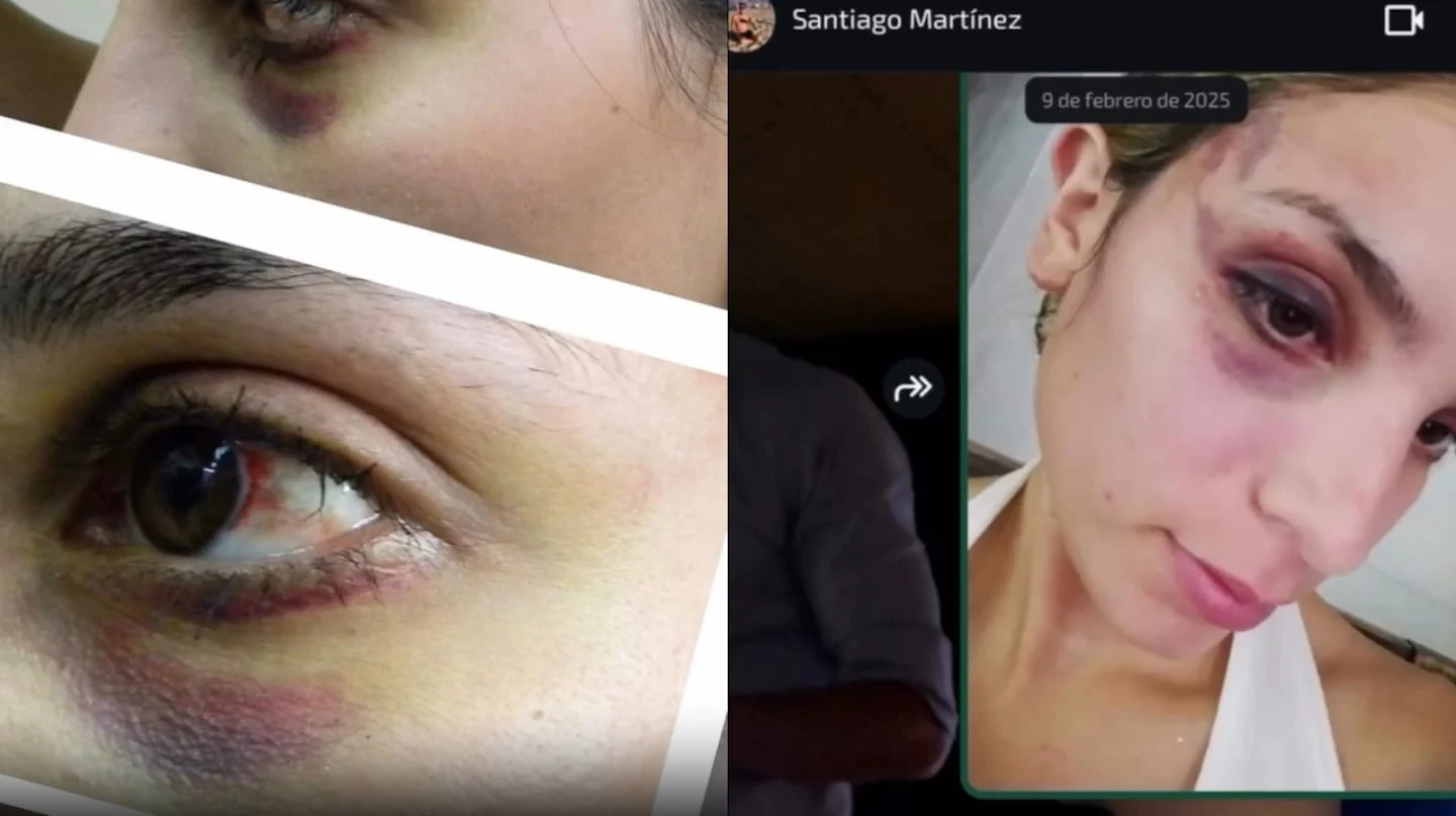 Imágenes de lesiones en el rostro de Emily Ceco tras amenazas de Santiago Martínez